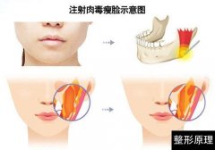 玻尿酸祛魚尾紋會有副作用嗎?