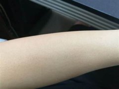 激光手臂脫毛會(huì)不會(huì)痛呢?