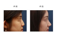 呼市假體隆鼻適合哪些人呢?