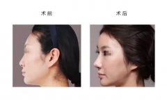 呼市假體隆鼻材料如何選擇?