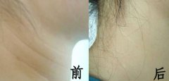 呼市注射除皺有什么好處?