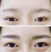 呼市黑眼圈如何治療?