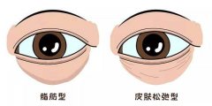 呼市脂肪型眼袋怎么去除?
