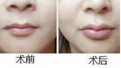 呼市豐唇方法好嗎怎樣護(hù)理?
