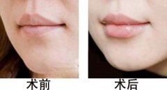 呼市注射豐唇術(shù)的材料有哪些?