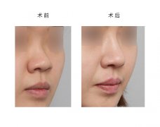 呼市假體隆鼻手術(shù)過程有哪些?
