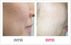呼市鉑金美白針效果與價格有哪些?