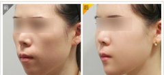 呼市自體脂肪豐面頰術(shù)后如何護理?