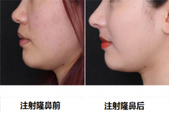呼市注射隆鼻修復(fù)有哪些方法?