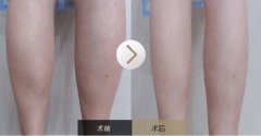 呼市射頻瘦小腿效果怎樣?