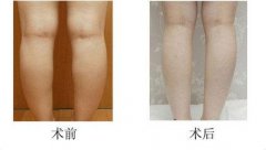 呼市小腿吸脂減肥哪些特點呢?
