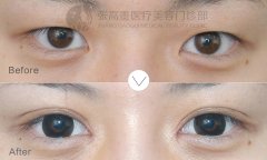 呼市做開眼角手術(shù)后有需要注意的嗎?