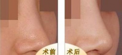 呼和浩特做鼻翼縮小術(shù)會有風(fēng)險嗎?