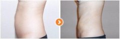 呼和浩特腰腹部吸脂價(jià)格是怎么定義的呢?