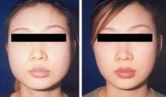 呼和浩特去頰脂墊瘦臉貴不貴?