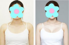 假體隆胸多久變得柔軟 注意事項(xiàng)