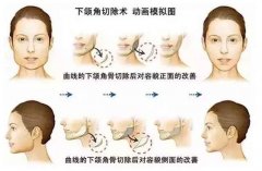 下頜角削骨手術是怎樣進行的