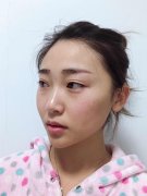 呼和浩特做面部吸脂的手術(shù)方法有哪些呢