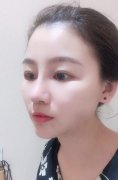 假體隆下巴材料都有哪些?術(shù)后護(hù)理怎么做?